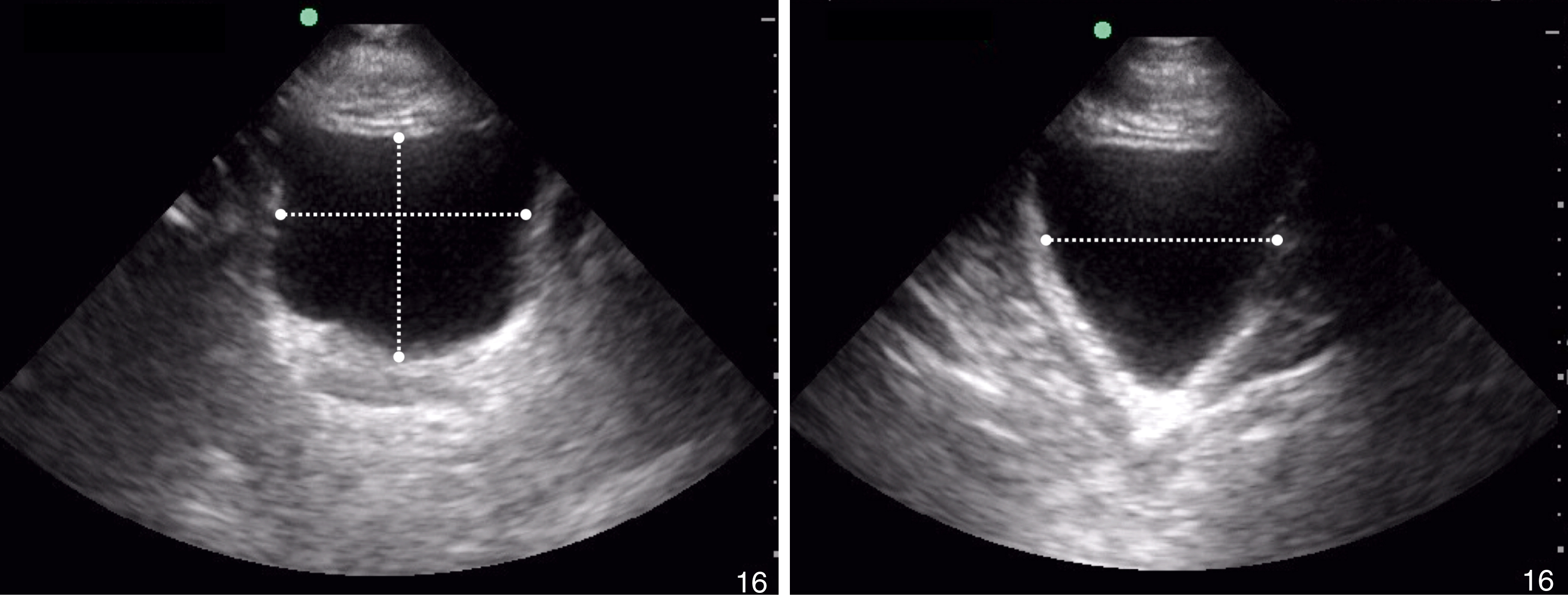 The Ultrasound shows two panels. Left panel—transverse view with width & AP diameter. Right panel—sagittal view with length, bladder is anechoic and distended. The Ultrasound shows two panels each demonstrating bladder volume measurements. The left panel shows a transverse view of the bladder with a cross-shaped dotted line showing measurements for both width and anteroposterior diameter. The bladder appears anechoic and distended. The right panel presents a sagittal view of the bladder, with a horizontal dotted line representing the measurement of its length.