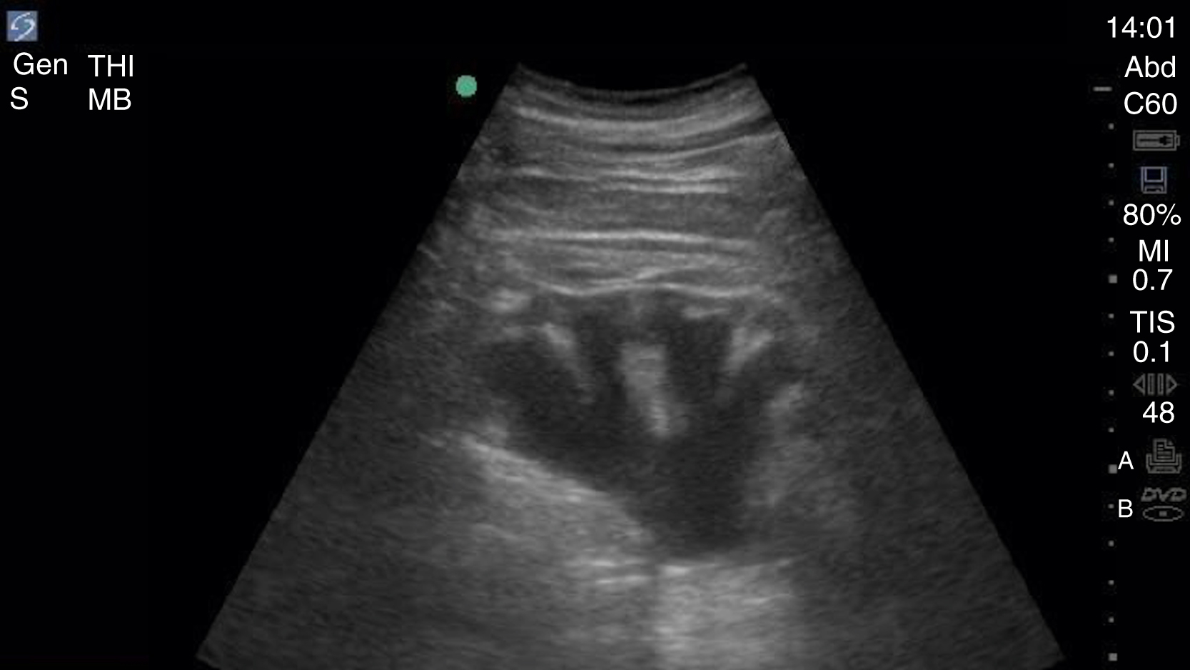 The ultrasound shows severe hydronephrosis. Markedly dilated calyces and renal pelvis as dark fluid areas, with a thinned, compressed renal cortex around the periphery. An ultrasound shows a kidney affected by severe hydronephrosis. The central portion of the kidney shows significant dilation of the calyces and renal pelvis, appearing as enlarged, dark, fluid-filled areas. The outer rim of the kidney, representing the renal cortex, appears noticeably thinned and compressed. The overall ultrasound shows a substantial accumulation of urine within the kidney, characteristic of severe hydronephrosis.