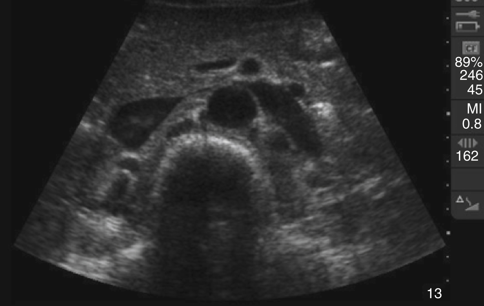 The Ultrasound shows a transverse view of aorta as a large dark circular anechoic structure, surrounded by smaller dark tubular vessels and abdominal structures.