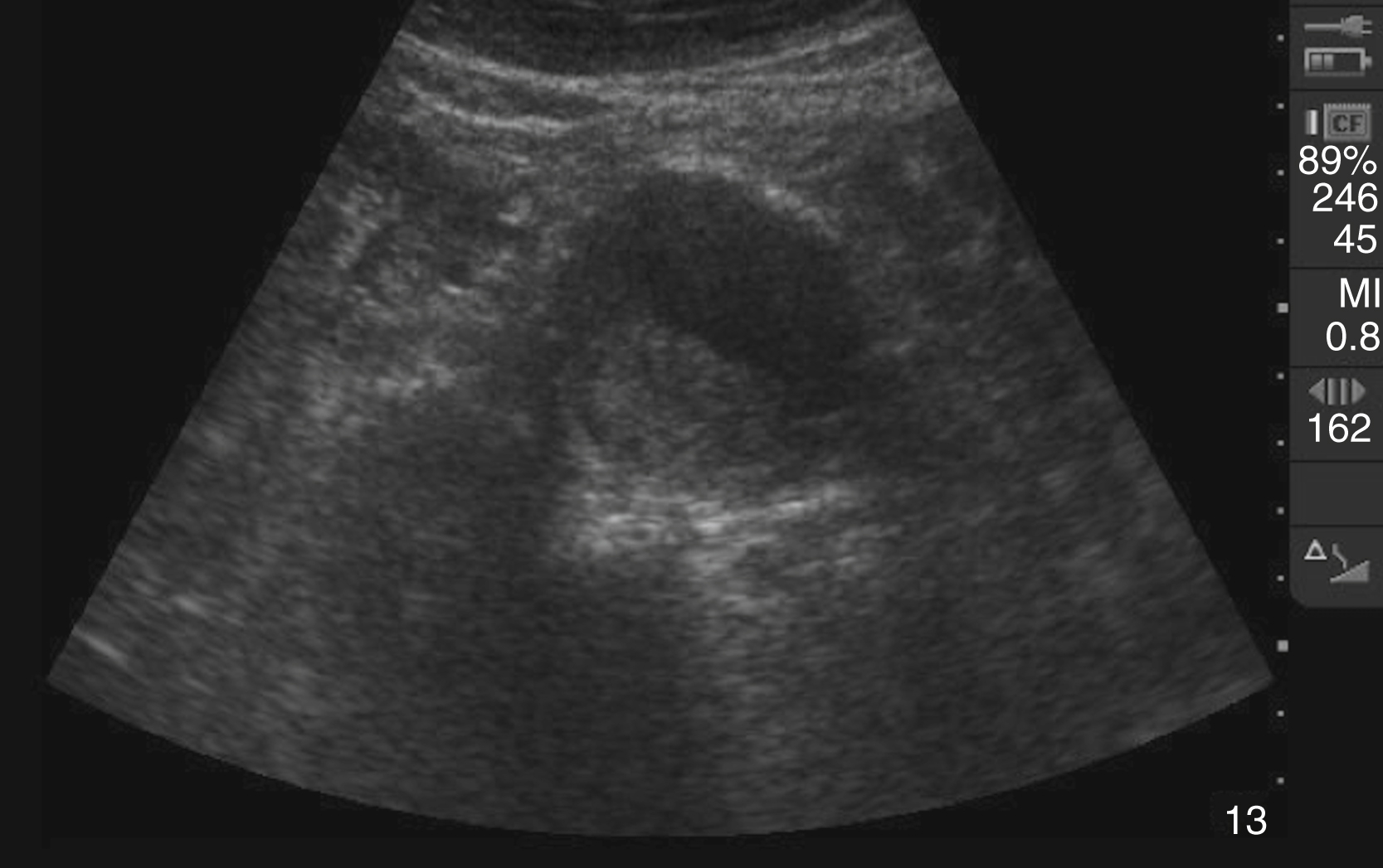The Ultrasound shows a transverse view of an abdominal aortic aneurysm (AAA) with a mural thrombus. The aorta appears significantly dilated, much larger than its normal size, and within its lumen.