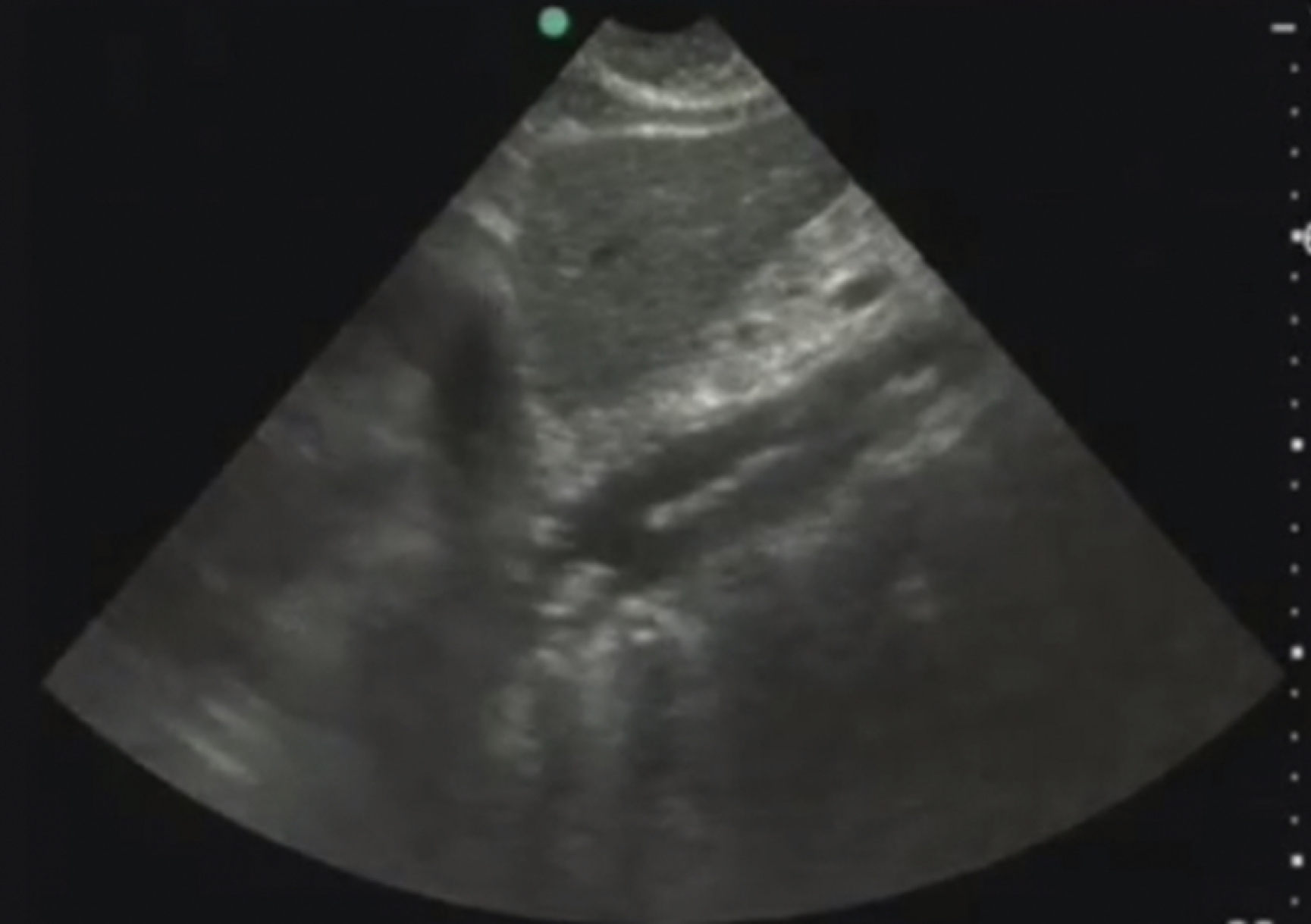 The Ultrasound shows a longitudinal view of the aorta with an aortic dissection flap. A bright, wavy dissection flap dividing true and false lumens, dark lumen and surrounding tissues are also seen.