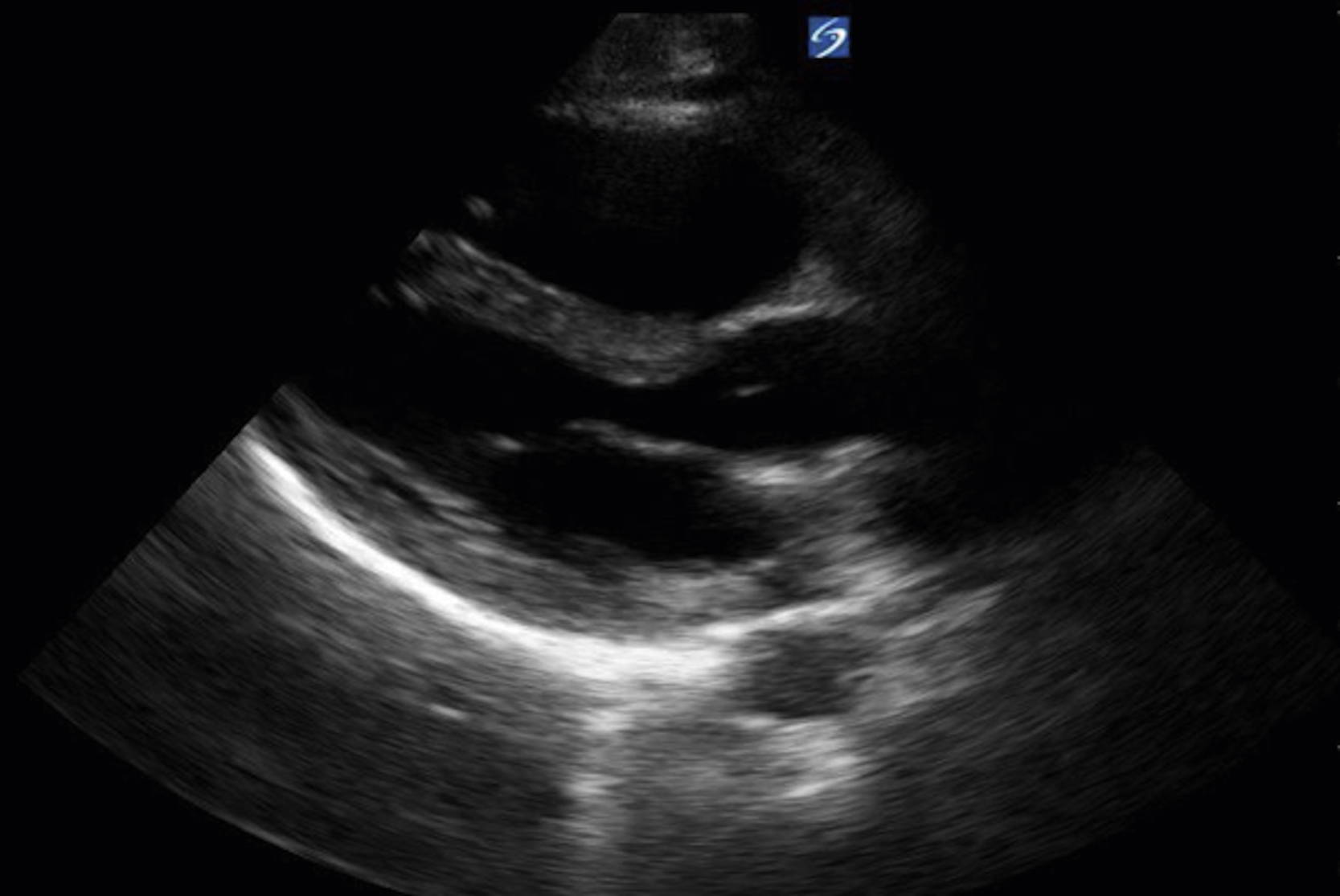 The Ultrasound shows a normal parasternal long-axis view of the heart. The ultrasound shows the left ventricle, left atrium, aortic root, and aortic valve.