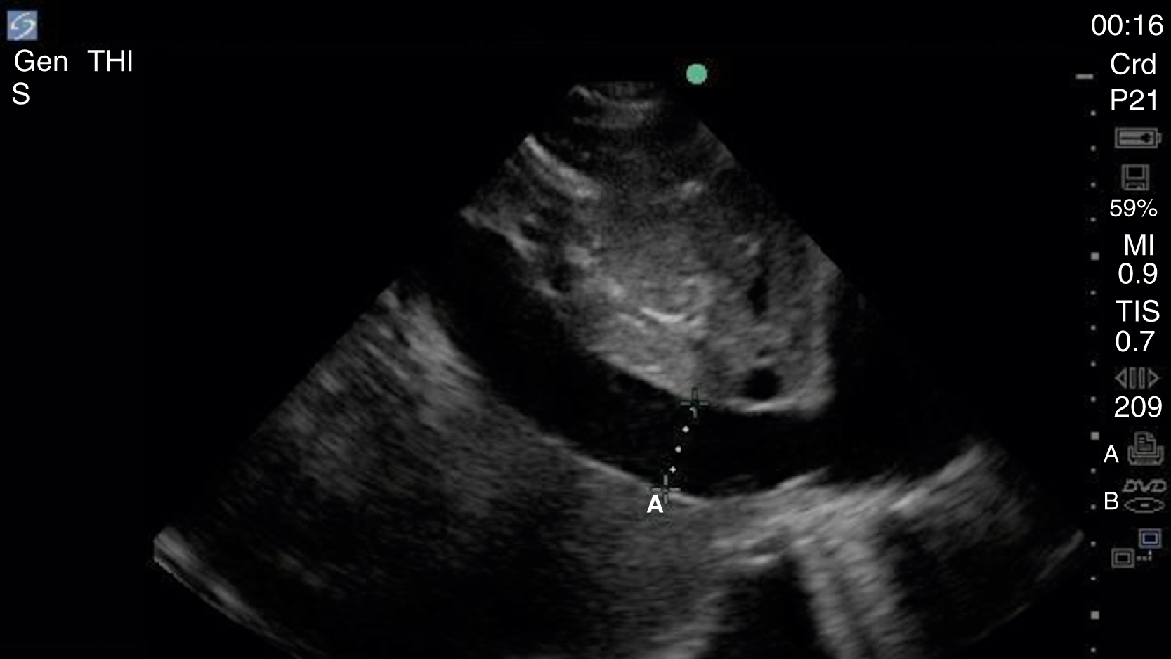 The Ultrasound shows a plethoric Inferior Vena Cava (IVC), large, dark, dilated tubular structure with little to no respiratory variation, showing high central venous pressure.