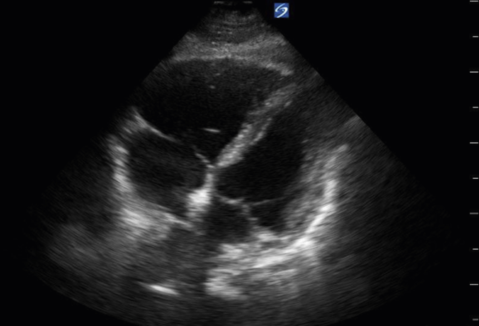 The Ultrasound shows a apical 4-chamber view, a dilated RV larger than the LV, septum appears flattened or bowed toward LV, and shows elevated RV pressure. The Ultrasound shows an apical 4-chamber view of the heart, showing an enlarged right ventricle (RV). The RV cavity, located on the right side of the Ultrasound, appears significantly dilated compared to the left ventricle (LV), which is on the left. The interventricular septum, separating the two ventricles, may appear flattened or bowed towards the left ventricle due to the increased pressure in the RV.