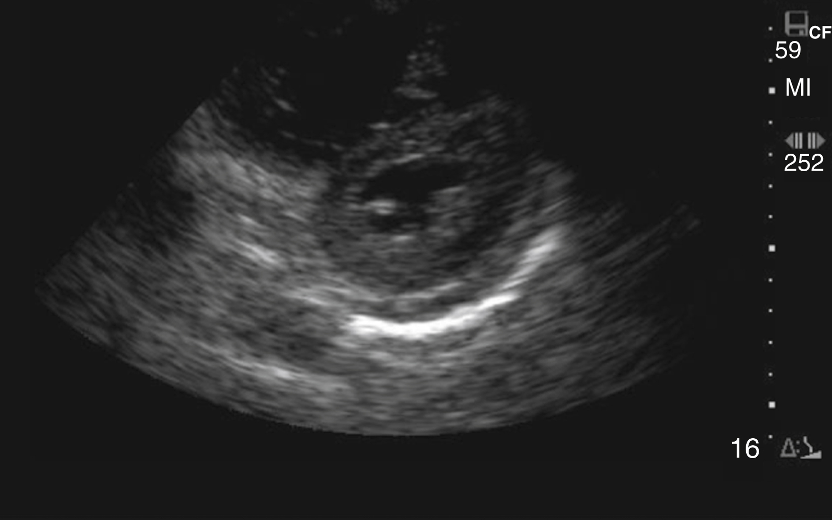 The Ultrasound shows a parasternal short-axis view of the heart, demonstrating the “D” sign. LV appears D-shaped as septum flattens from high RV pressure, normally LV should look circular. The Ultrasound shows a parasternal short-axis view of the heart, demonstrating the “D” sign, which signifies increased right ventricular (RV) pressure. In this view, the left ventricle (LV) normally appears circular. However, due to the pressure exerted by the enlarged or hypertrophied RV, the interventricular septum is flattened and pushed into the LV cavity, causing the LV to appear distinctly D-shaped.