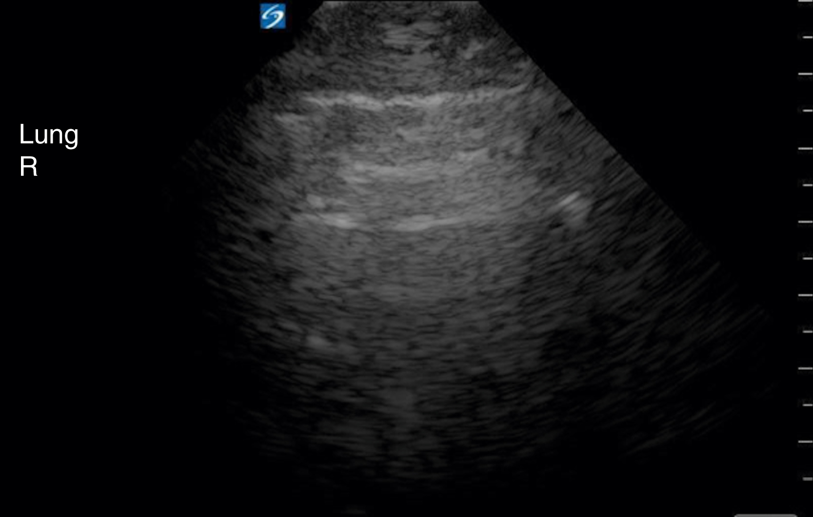 The Ultrasound shows the lung. “A-lines,”. These A-lines are reverberation artifacts, revealing the presence of air in the lung and signifying a normal lung ultrasound.