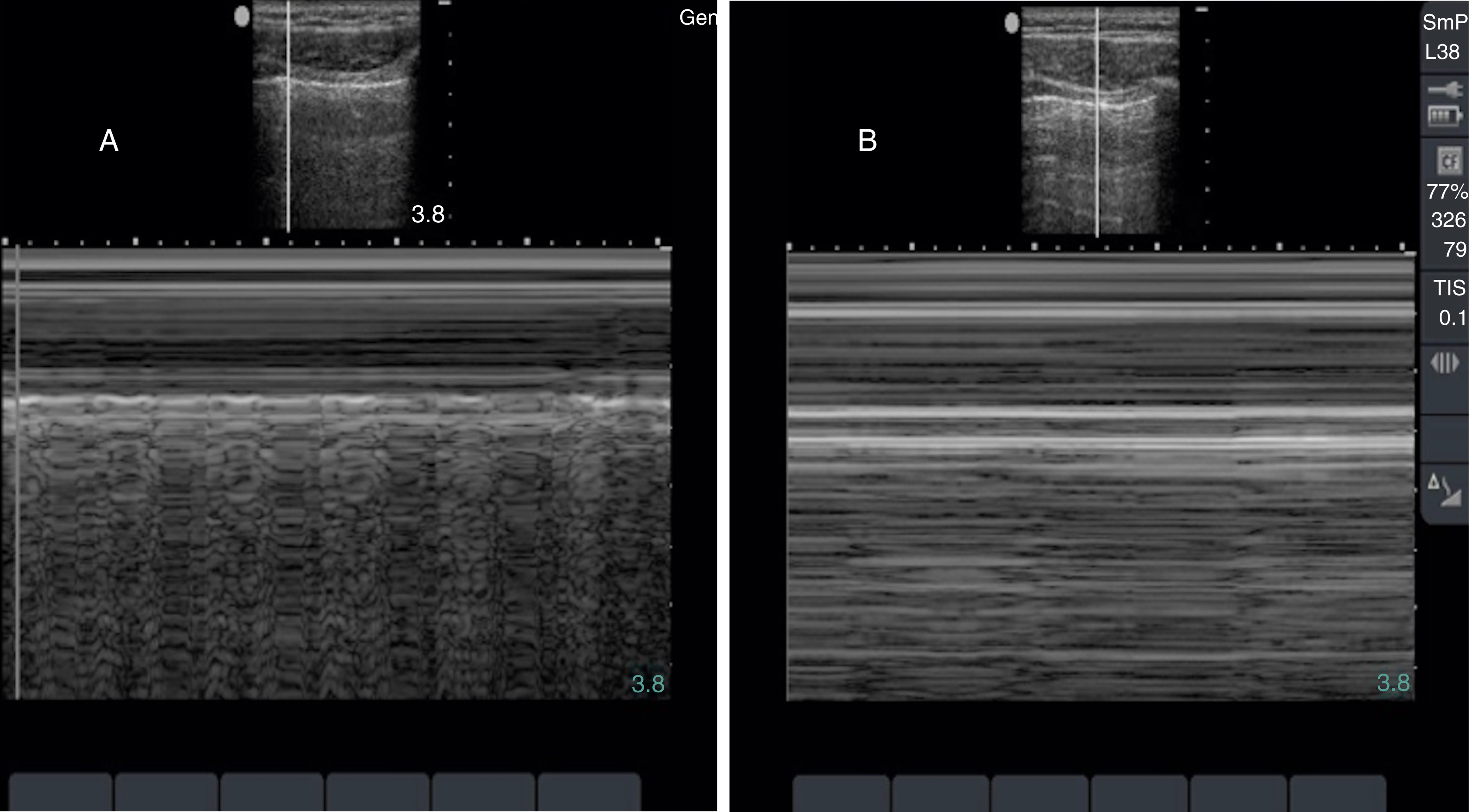 The Ultrasound set of two panels. A shows hydronephrosis, normal lung seashore sign. B shows normal aorta and barcode sign shows pneumothorax with absent lung sliding. The Ultrasound shows a set of two panels A,B in which a various findings related to the abdomen, heart, and lungs. A shows a kidney with severe hydronephrosis, characterized by significant dilation of the renal pelvis and calyces and a thinned renal cortex. The horizontal reverberation artifacts revealing normal, air-filled lung, and two M-mode scans showing the “seashore sign” for normal lung sliding. B shows a normal transverse view of the aorta, appearing as a clear, anechoic circular structure. The “barcode” or “stratosphere” sign, indicative of pneumothorax due to absent lung sliding.