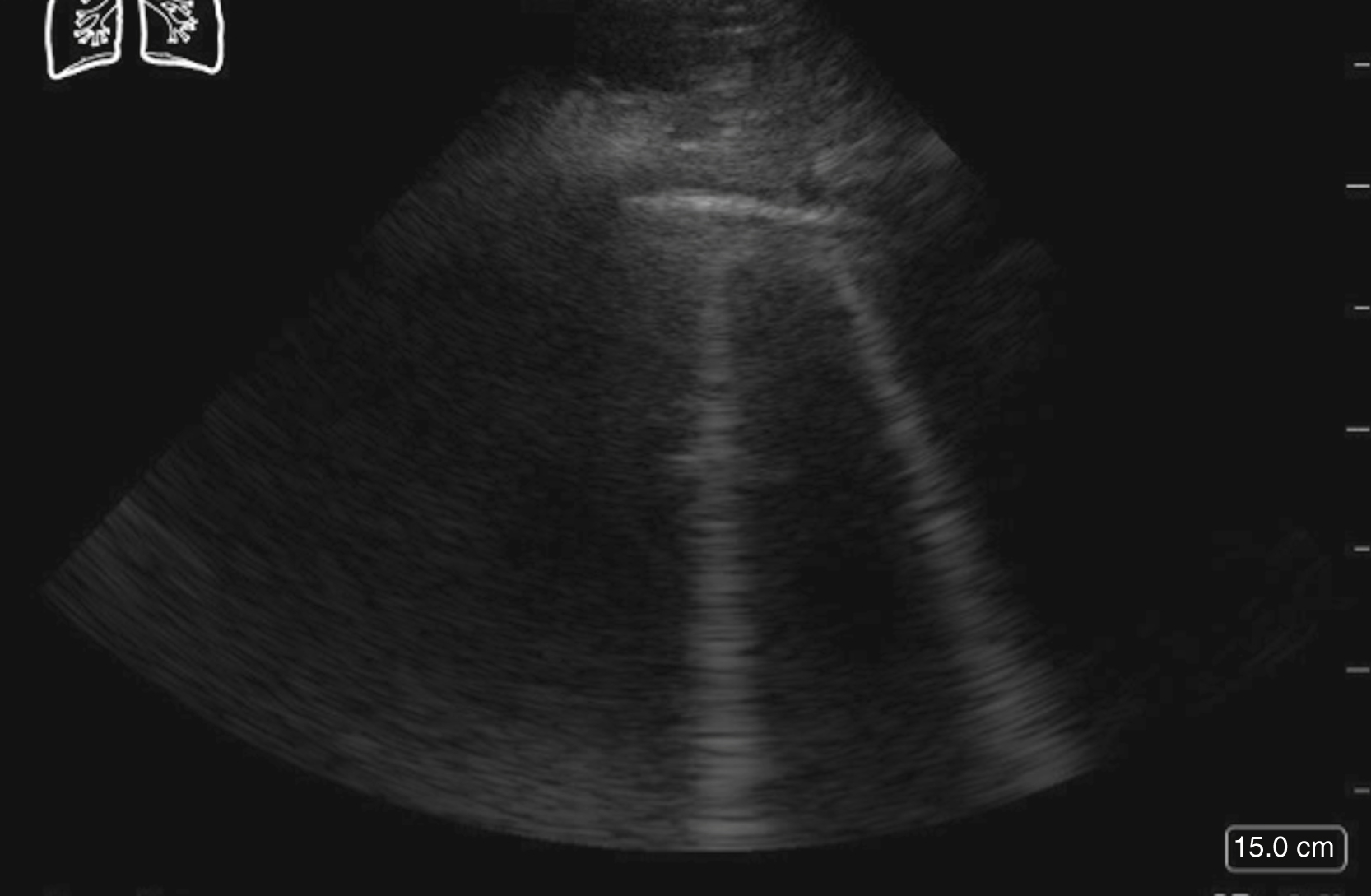 The Ultrasound of a lung shows vertical, hyperechoic lines, known as B-lines, extending from the pleural line to the bottom of the screen, showing the presence of fluid within the lung tissue.