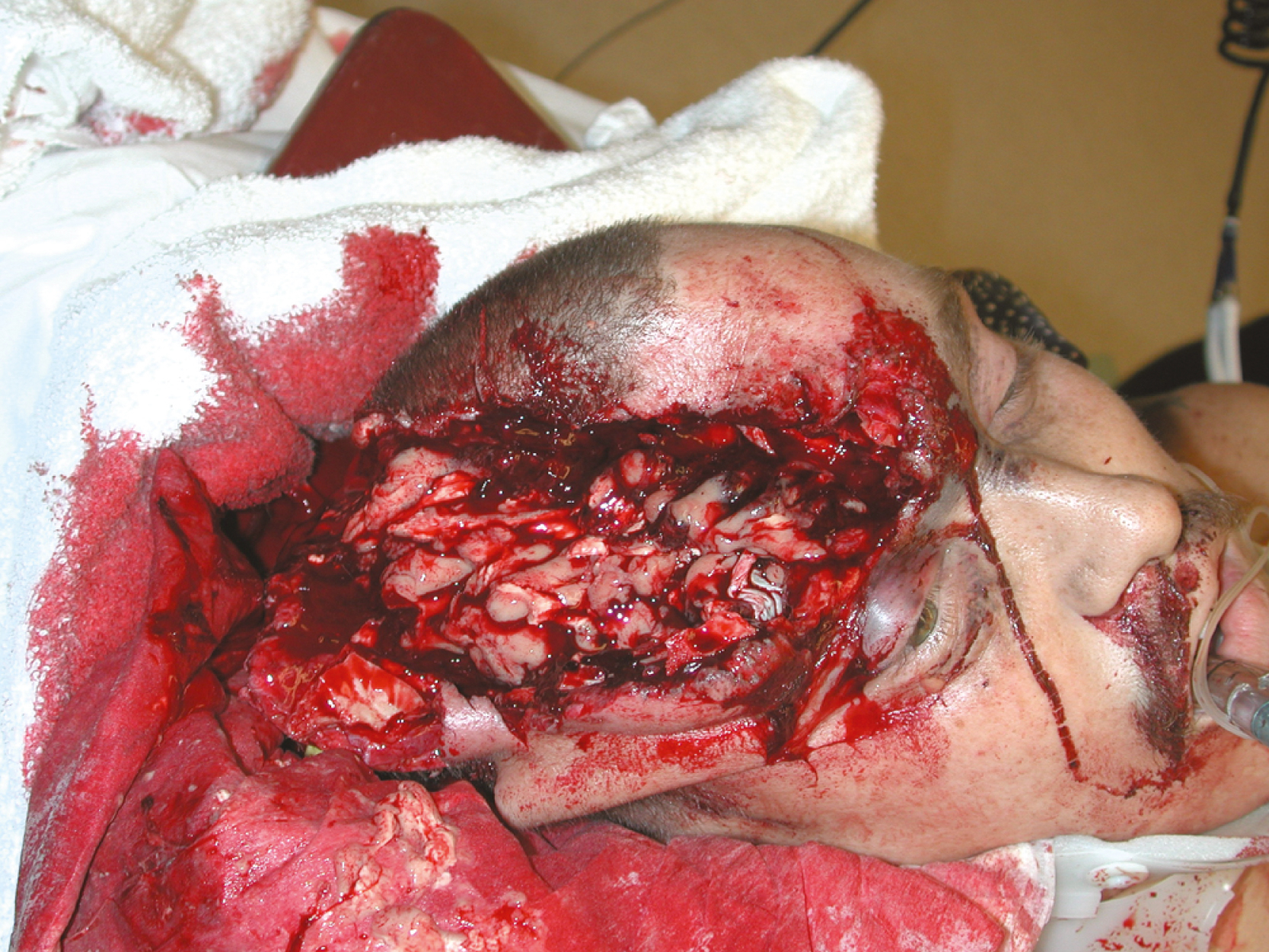 The diagram shows a patient with a severe head injury caused by a high-velocity gunshot wound. The forehead and surrounding facial structures are extensively damaged, with significant tissue loss.