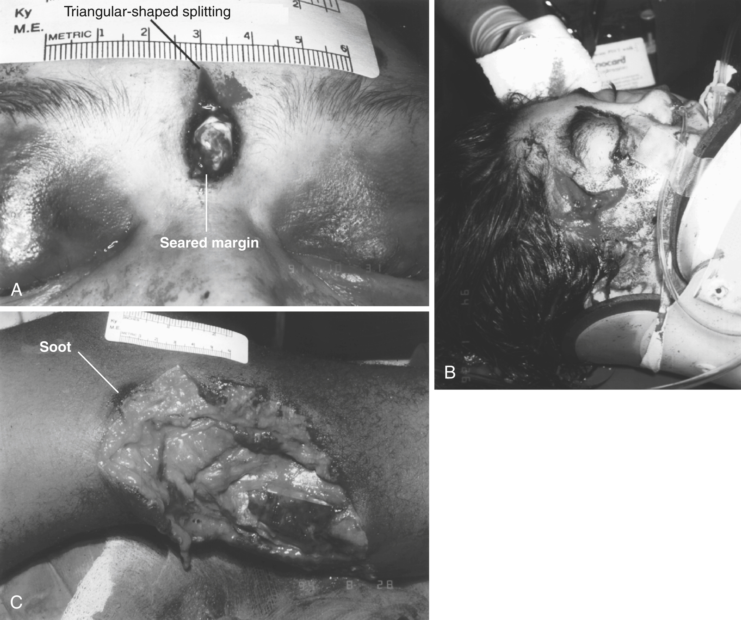The photograph shows three gunshot wounds: forehead with triangular split and seared edges, severe facial tearing from tight-contact shot, and calf wound with soot and major tissue damage. The photograph shows three gunshot wounds. The first is a close-up of a tight-contact entrance wound on the forehead with triangular-shaped splitting and seared wound margins. The second image shows a severe facial injury with extensive tissue tearing from a tight-contact entrance wound. The third image depicts a gunshot wound on the medial aspect of the left calf with visible soot, shows close-range fire, and large tissue damage exposing underlying structures.