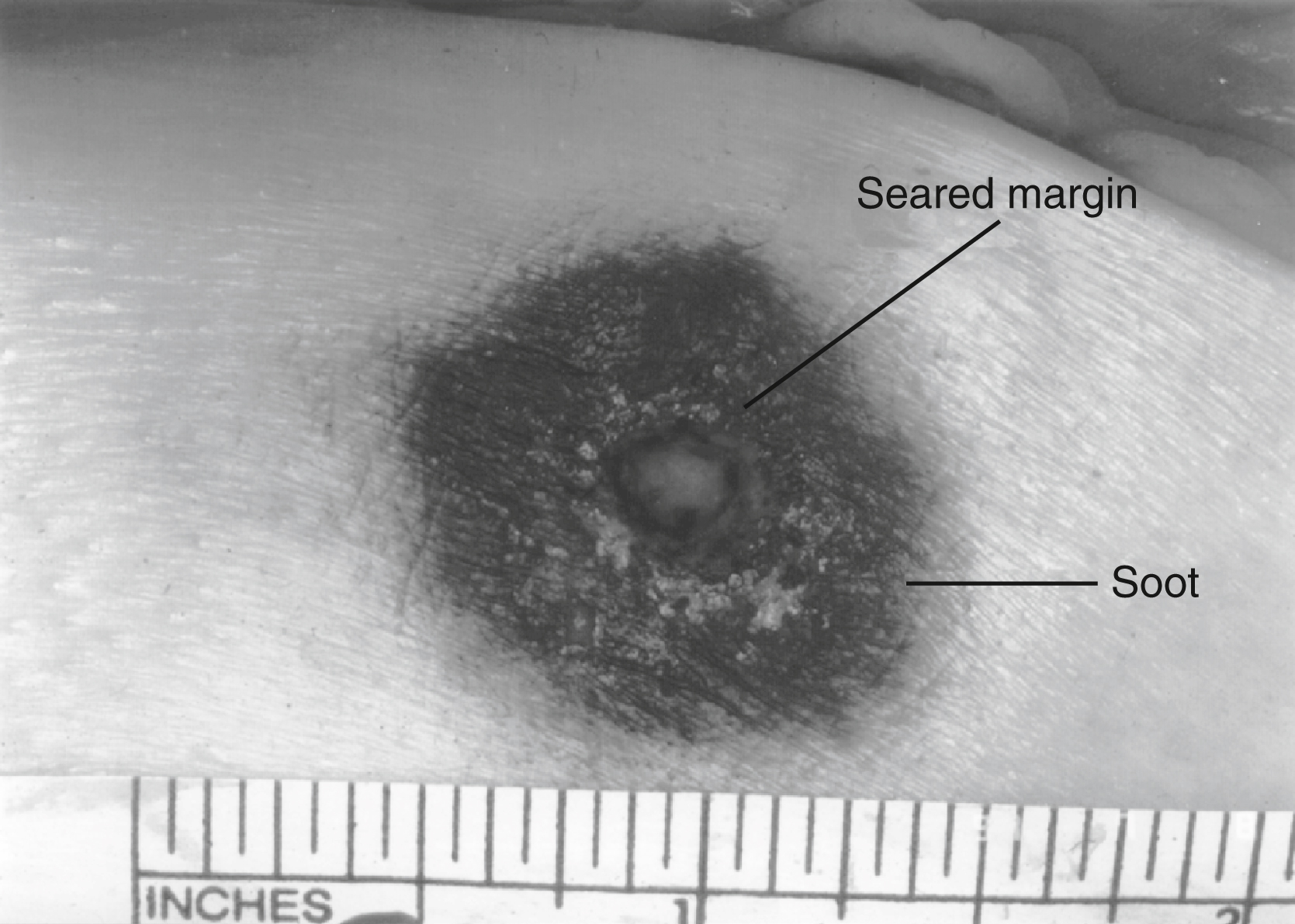 The photograph shows close-range gunshot wound with soot deposition around a central entry point, and seared wound margins, shows a firing distance of about 6 inches (15 cm) or less.