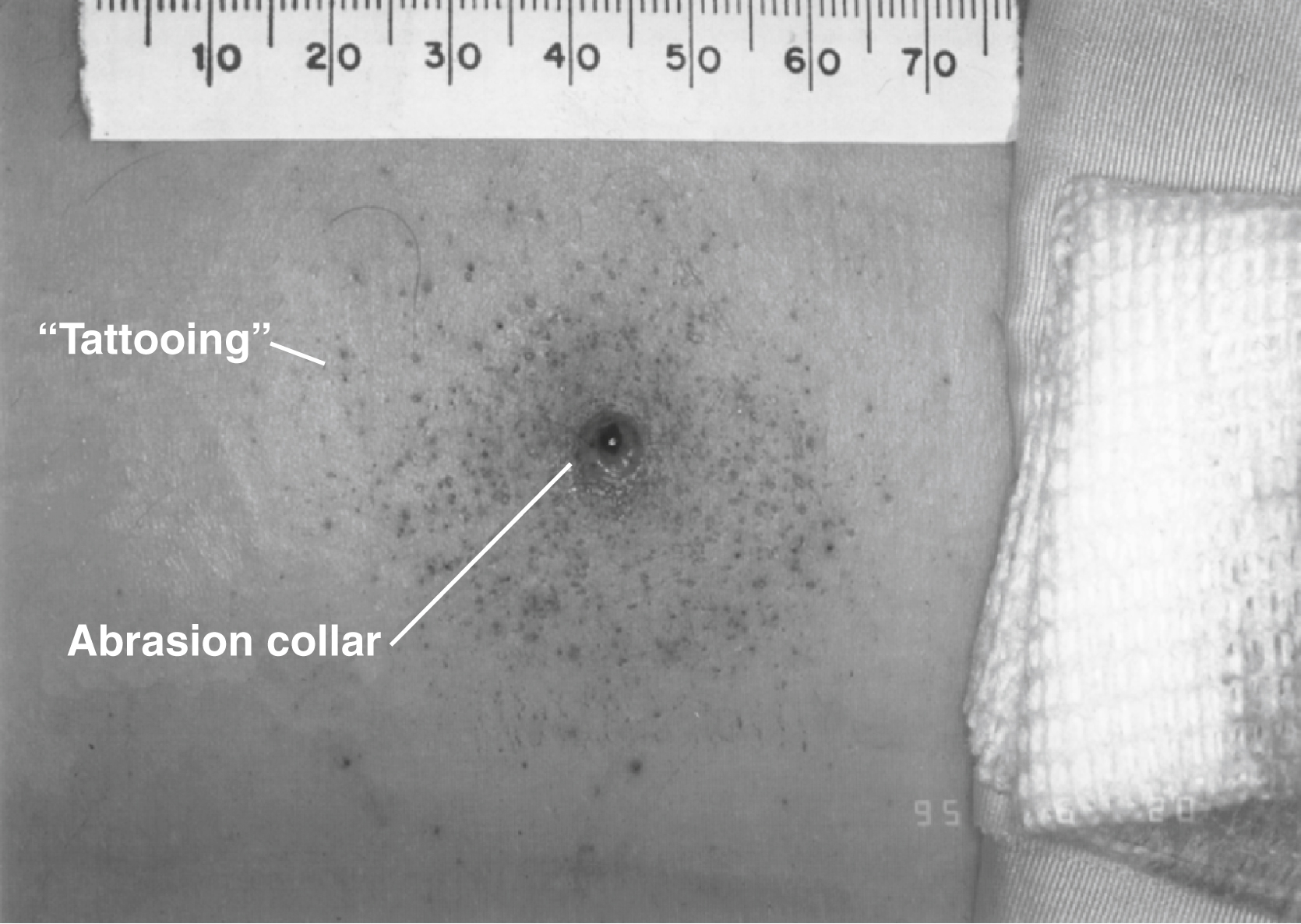 The photograph shows gunshot wound with abrasion collar around the entry point and surrounding tattooing caused by unburned gunpowder particles embedded in the skin, shows intermediate-range fire.