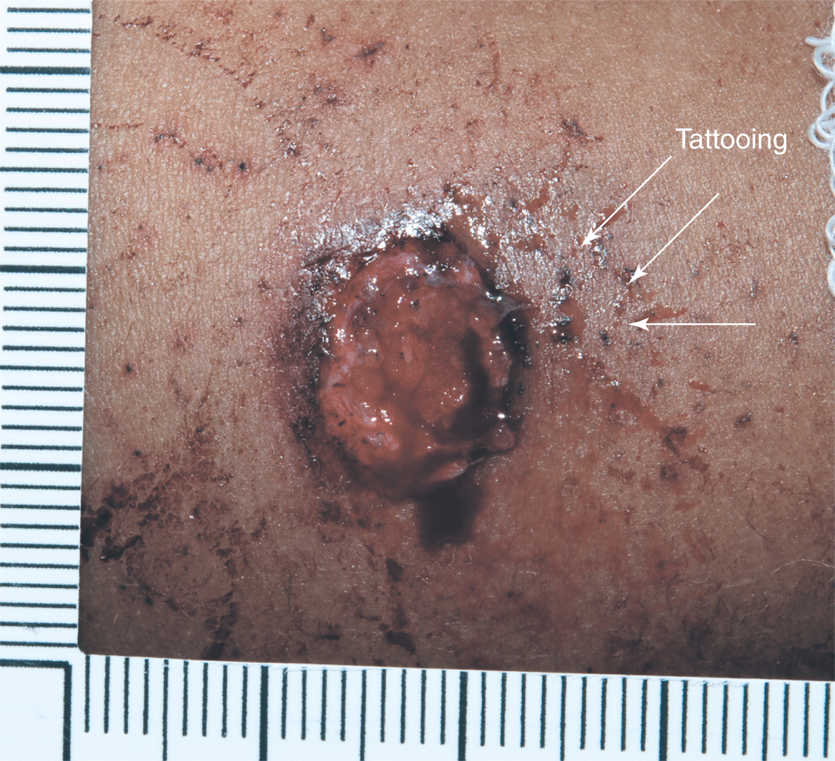 The photograph shows close-range gunshot wound with a large central defect and surrounding tattooing from unburned gunpowder particles embedded in the skin, shows penetration through thin clothing.