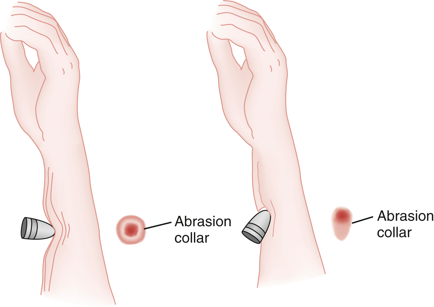 The illustration shows the bullet entrance wounds on an arm, each surrounded by an abrasion collar, which is the abraded area formed by friction as the bullet passes through the skin.
