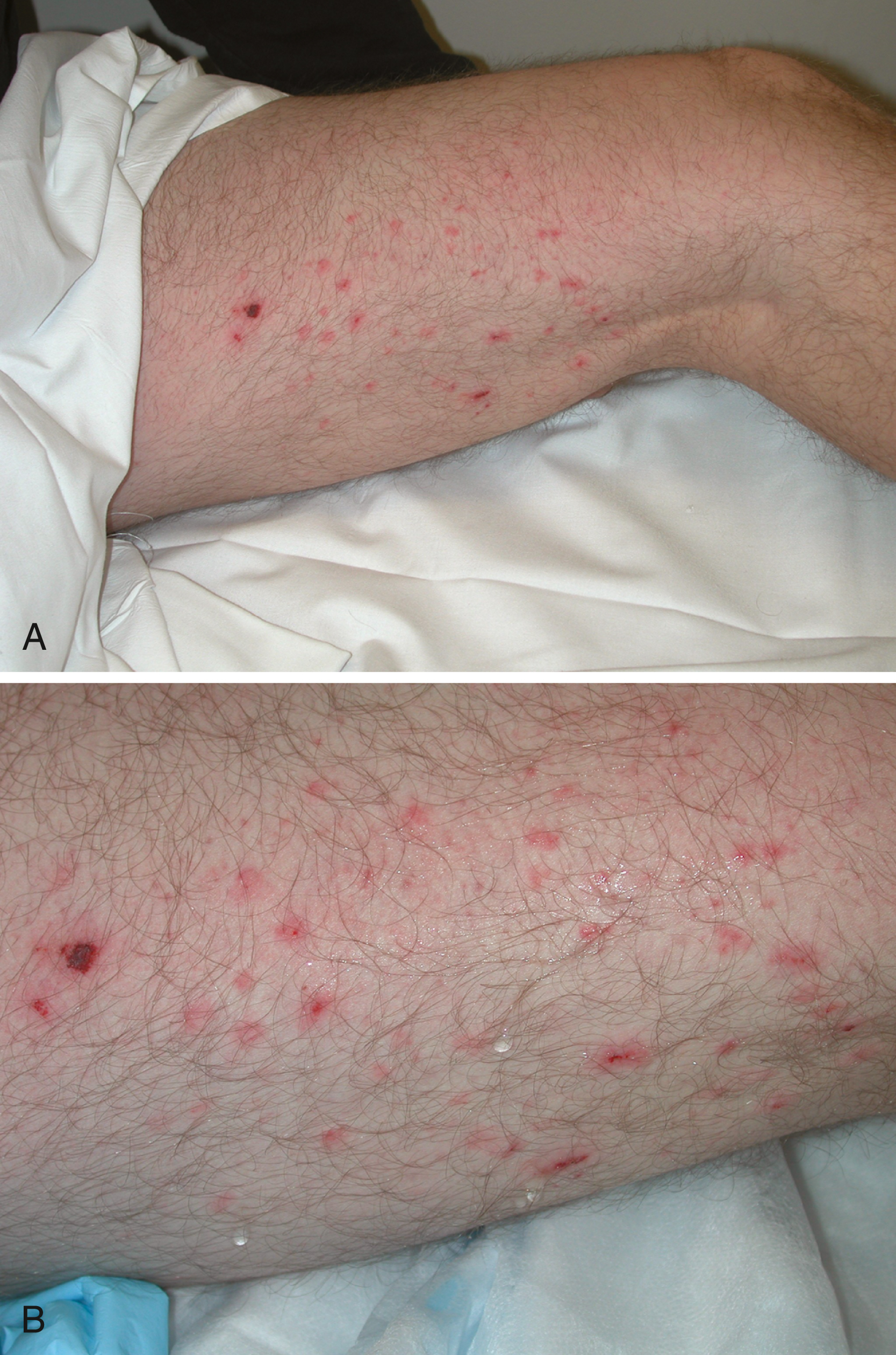 A set of two photograph shows a thigh with multiple small red punctate abrasions caused by glass fragments, creating a pseudotattooing pattern after a gunshot round penetrated a windowpane.