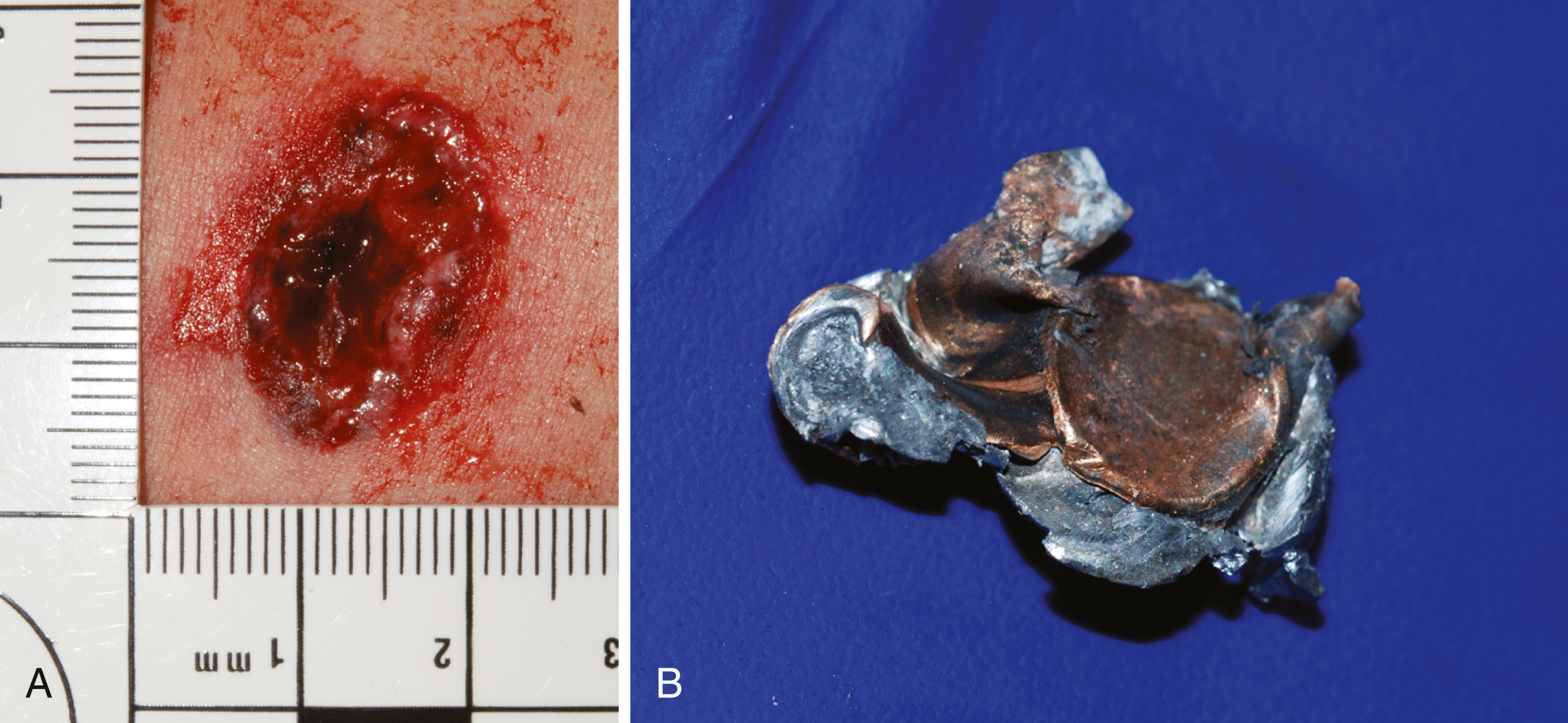 A set of two photograph shows A and B. A, an atypical entrance wound with irregular tearing and rulers for scale. B, a deformed.40 caliber bullet twisted and flattened after hitting a windshield. A set of two photograph shows A and B. A shows an atypical entrance wound on the skin with irregular tearing and tissue damage, with rulers measuring the wound. B shows a deformed.40 caliber bullet projectile after impact, twisted and flattened from penetrating a windshield.