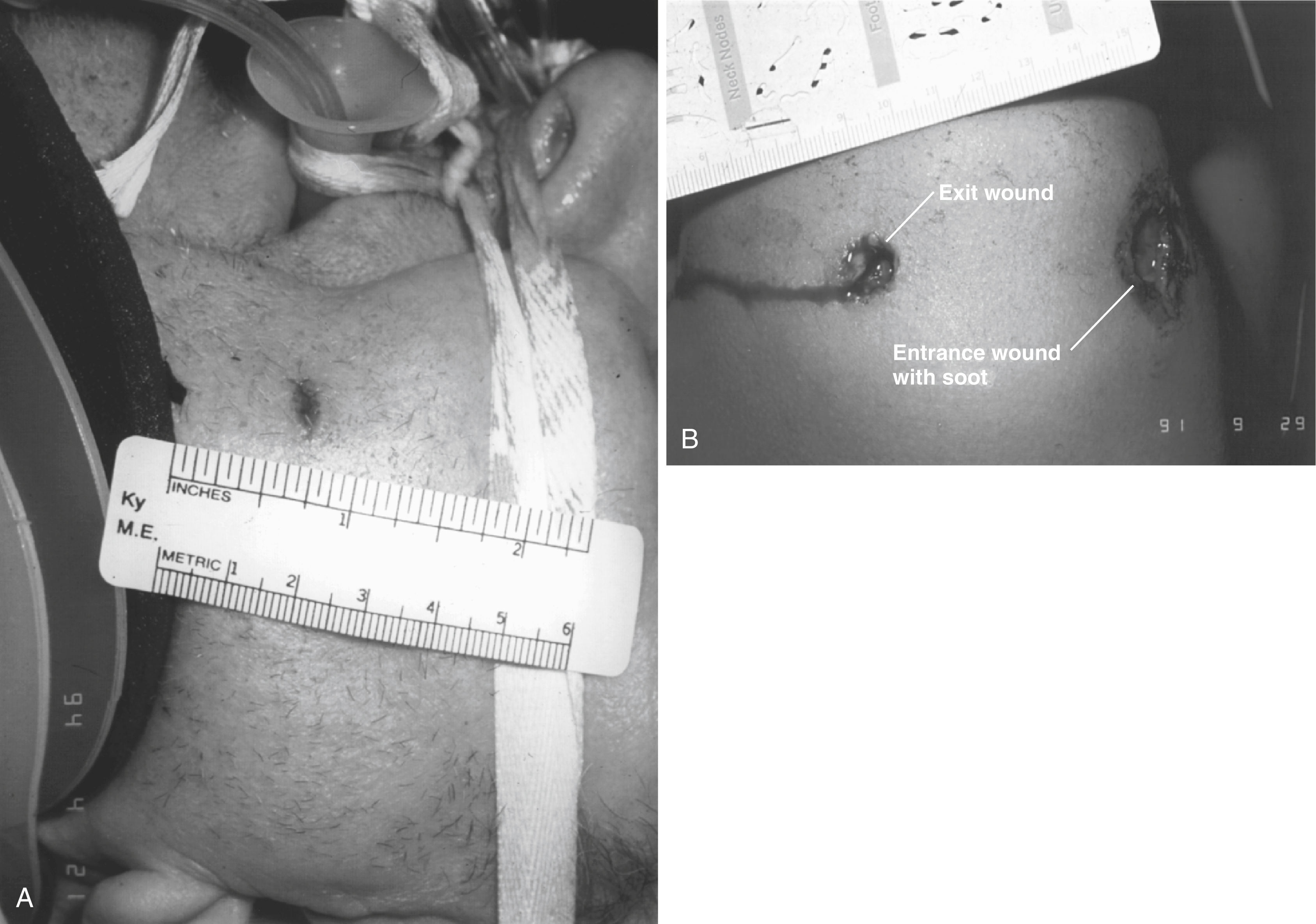 A set of two photograph shows A and B. A shows a slit exit wound on the neck with a Ky M.E. ruler in inches and metric. B shows an entrance wound with soot and a smaller exit wound on the deltoid. A set of two photograph shows A and B. A shows a slit exit wound on the neck with a ruler marked Ky M.E. in inches and metric units for scale. B shows a perforating gunshot wound on the left deltoid area with an entrance wound with soot and a smaller exit wound, both labeled, with a ruler for measurement above the wounds.