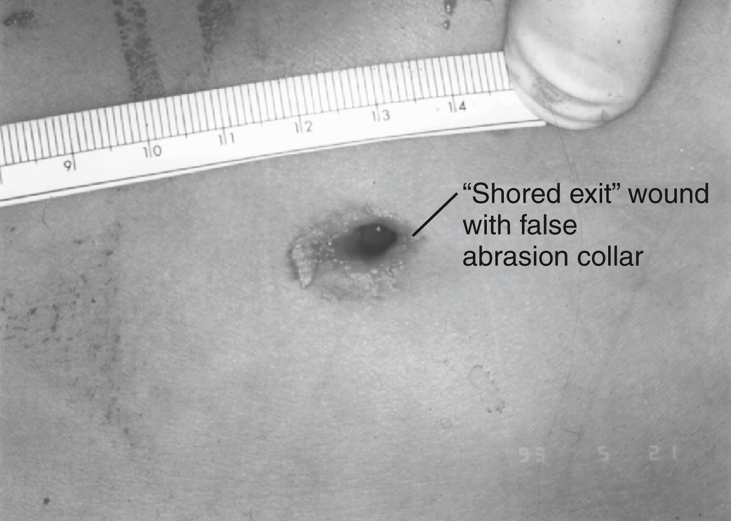 The photograph shows a “Shored exit” wound with false abrasion collar labeled near the injury site. A ruler is placed above the wound for measurement, and a hand holds the ruler in place.