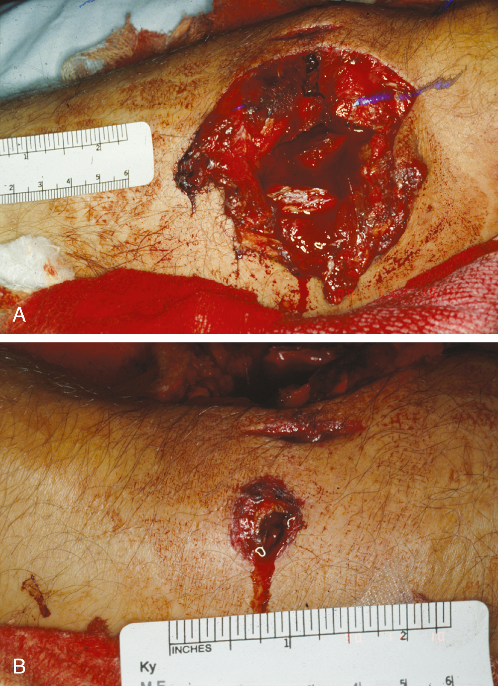 A set of two photograph shows A and B. A, a large exit wound from a high-velocity rifle round with tissue damage and a ruler for scale. B, a smaller entrance wound with an abrasion collar and ruler. A set of two photograph shows A and B. A shows a large exit wound from a high-velocity rifle round with extensive tissue damage and a ruler placed nearby for scale. B shows a smaller entrance wound from a high-velocity rifle round with an abrasion collar, also measured with a Ky ruler marked in inches.