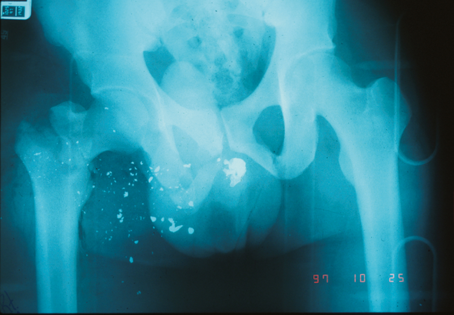 The X-ray of pelvis shows multiple tiny metallic fragments dispersed a snowstorm from a high-velocity rifle round, showing extensive bone impact and tissue damage.