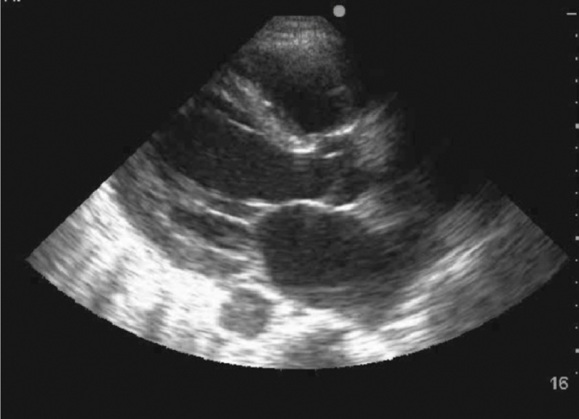 An echocardiogram demonstrates a distinct intracardiac mass with irregular margins, suggesting a possible thrombus or tumor within the heart chambers.