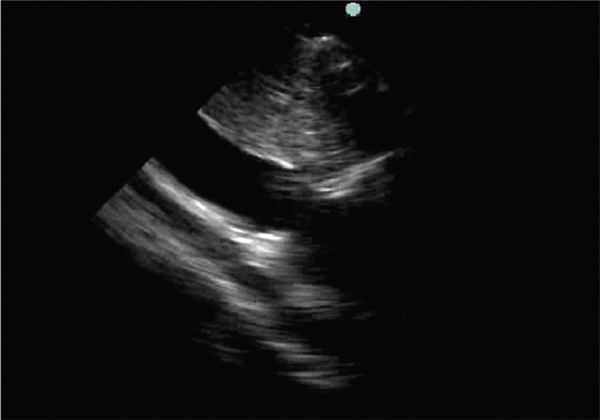 An echocardiogram shows elongated heart chambers with relatively thin walls, suggestive of possible dilated cardiomyopathy or volume overload state.