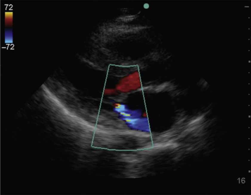 An echocardiogram with Doppler demonstrates turbulent flow across the heart chambers, indicating abnormal valvular function or shunting between chambers.