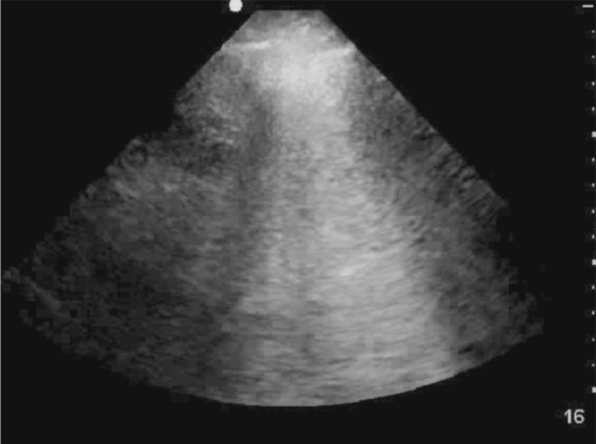 An echocardiogram shows diffusely bright myocardial texture and indistinct chamber definition, suggestive of myocardial infiltration or diffuse pathology.