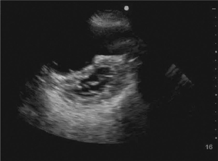 An echocardiogram reveals pericardial effusion with floating echogenic material suggestive of organized fibrin or clot in the pericardial space.