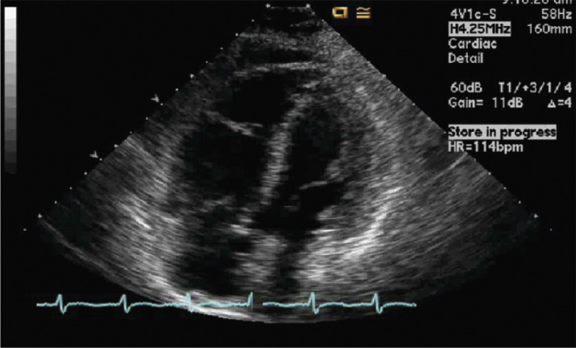 An echocardiogram four-chamber view demonstrates abnormal chamber filling with irregular endocardial surface, possibly due to valvular disease or infiltrative pathology.