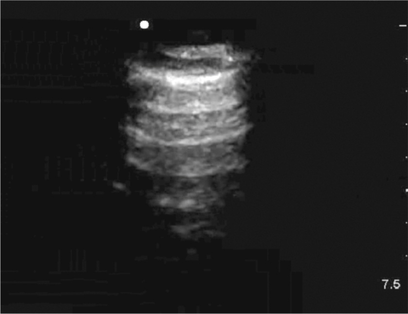An M-mode echocardiogram demonstrates abnormal ventricular wall motion with irregular systolic contraction pattern suggestive of regional wall motion abnormality.