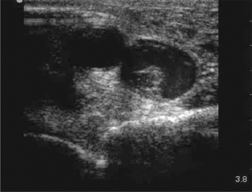 An ultrasound demonstrates aortic arch visualization with evidence of dilatation and irregular walls, suggestive of aneurysmal change or dissection.