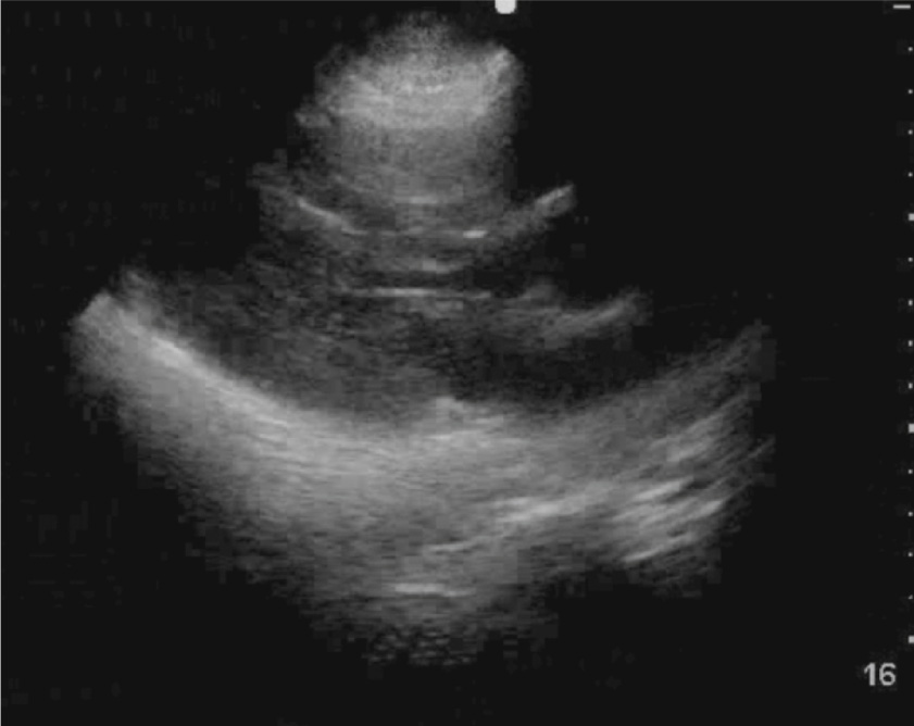 An echocardiogram depicts prosthetic valve structure with clear visualization of valve struts, consistent with aortic or mitral prosthetic valve in situ.