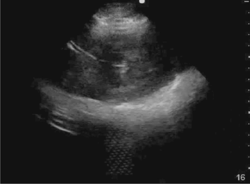 An echocardiogram shows a prosthetic valve with abnormal leaflet motion and possible associated regurgitation, suggesting dysfunction of the prosthetic valve.