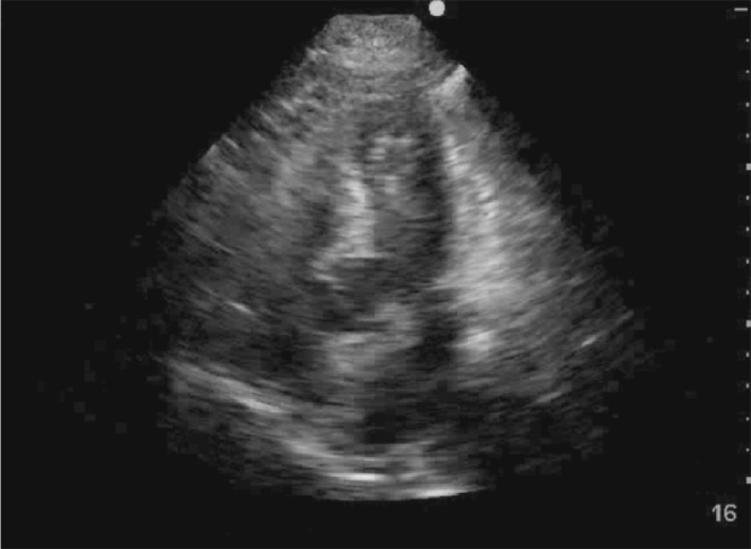 An echocardiogram demonstrates a four-chamber view with poorly defined cardiac walls and reduced structural clarity, suggestive of diffuse myocardial disease or artifact.