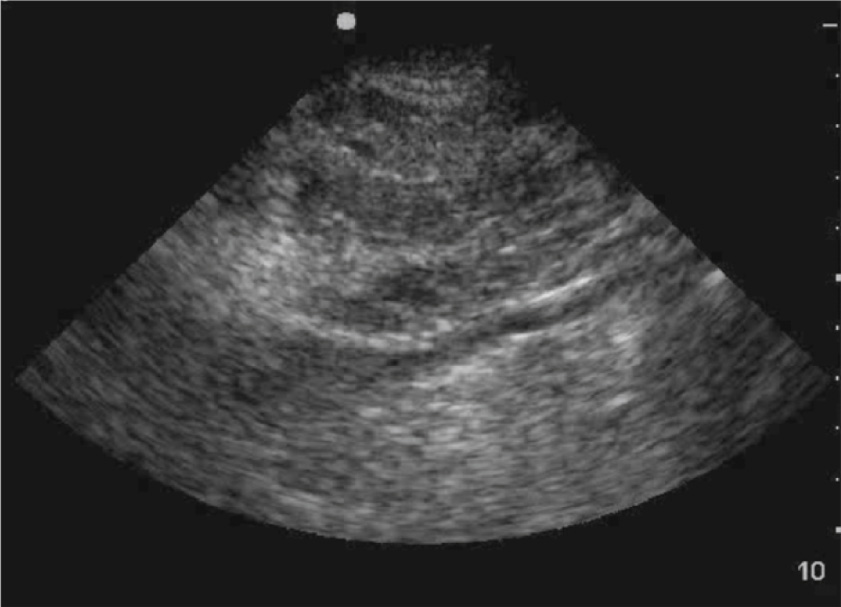 An echocardiogram demonstrates diffusely bright, speckled myocardial echotexture with reduced contrast between chambers and myocardium, consistent with infiltrative pathology.