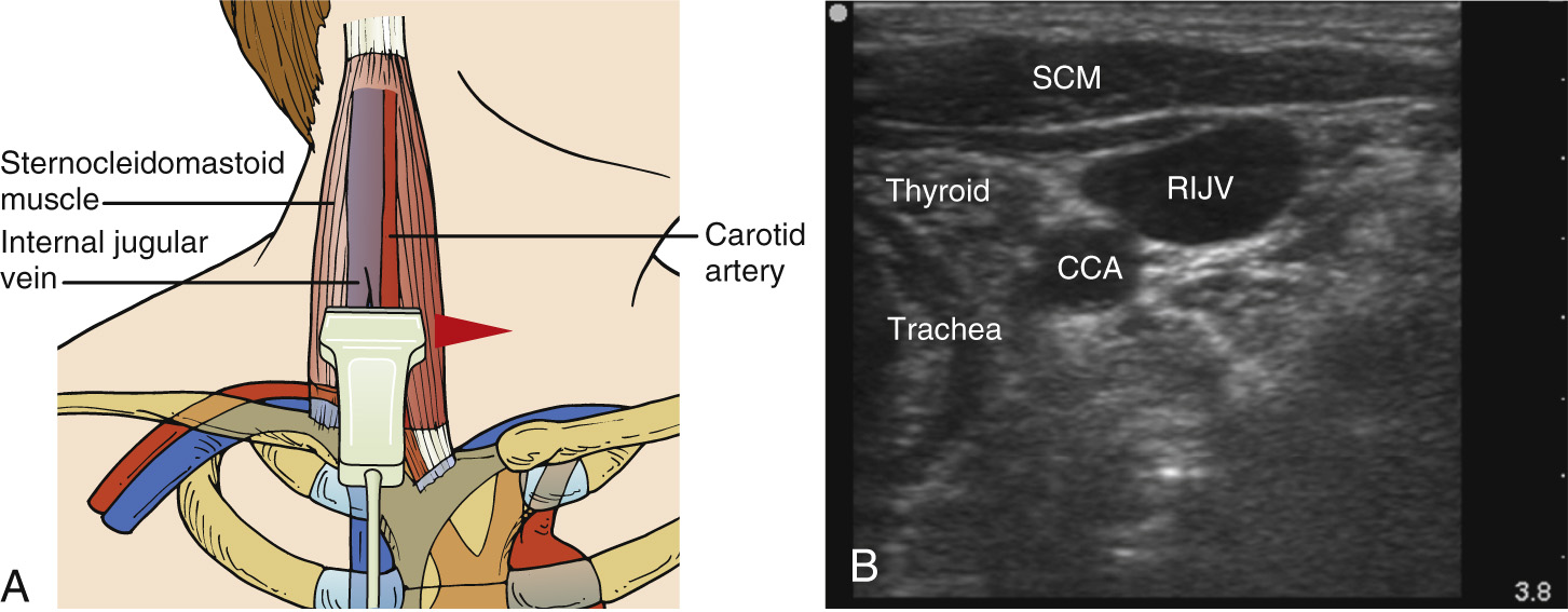 An anatomical drawing and ultrasound scan showing the relationship of the internal jugular vein, carotid artery, thyroid, trachea, and sternocleidomastoid muscle.