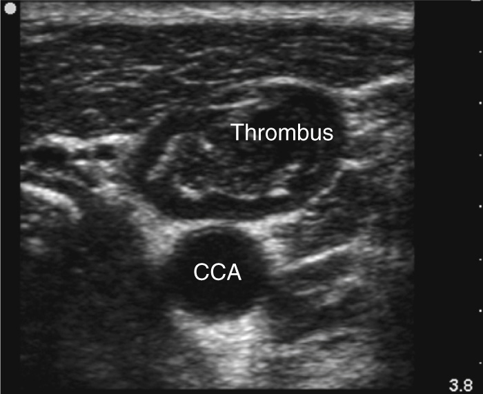 An ultrasound scan showing a thrombus above the common carotid artery.
