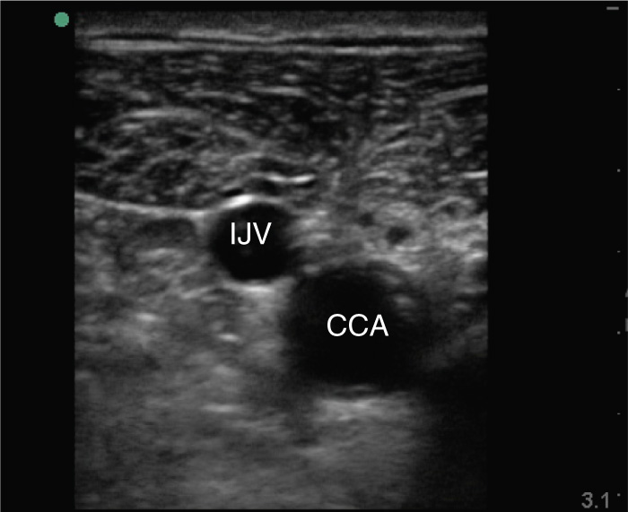 An ultrasound scan showing the internal jugular vein adjacent to the common carotid artery.