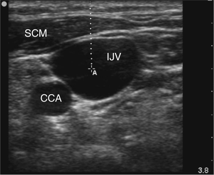 An ultrasound scan showing the internal jugular vein above the common carotid artery and beneath the sternocleidomastoid muscle.
