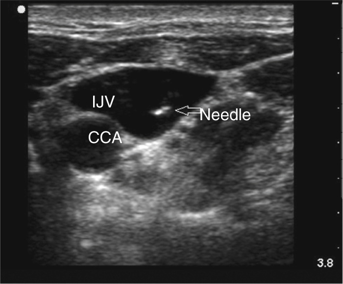 An ultrasound scan showing a needle entering the internal jugular vein next to the common carotid artery.