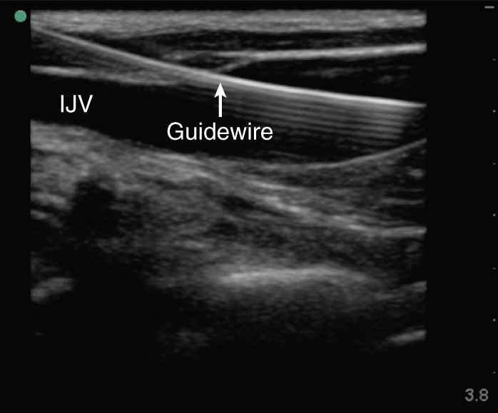 An ultrasound scan showing a guidewire positioned within the internal jugular vein.