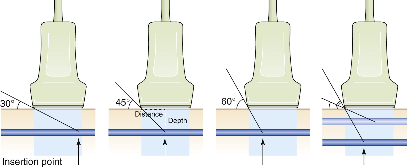 An ultrasound probe with needle insertion angles of 30, 45, and 60 degrees showing depth and distance relationships.