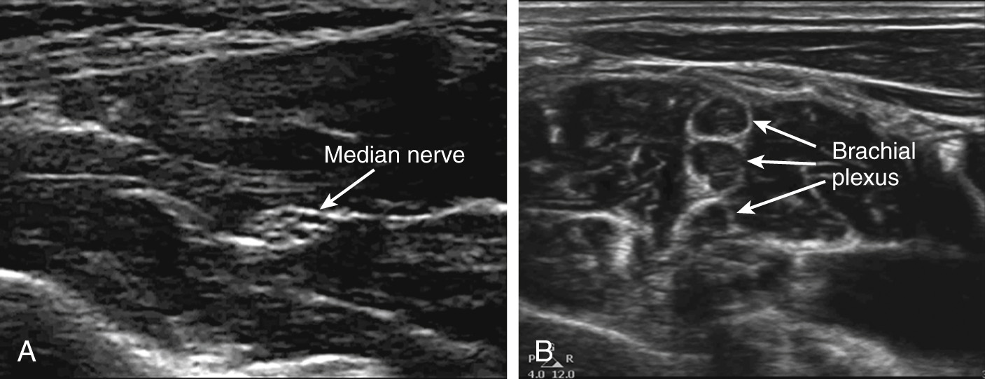 A two-part ultrasound scan labeled Part A and Part B with nerve structures.
