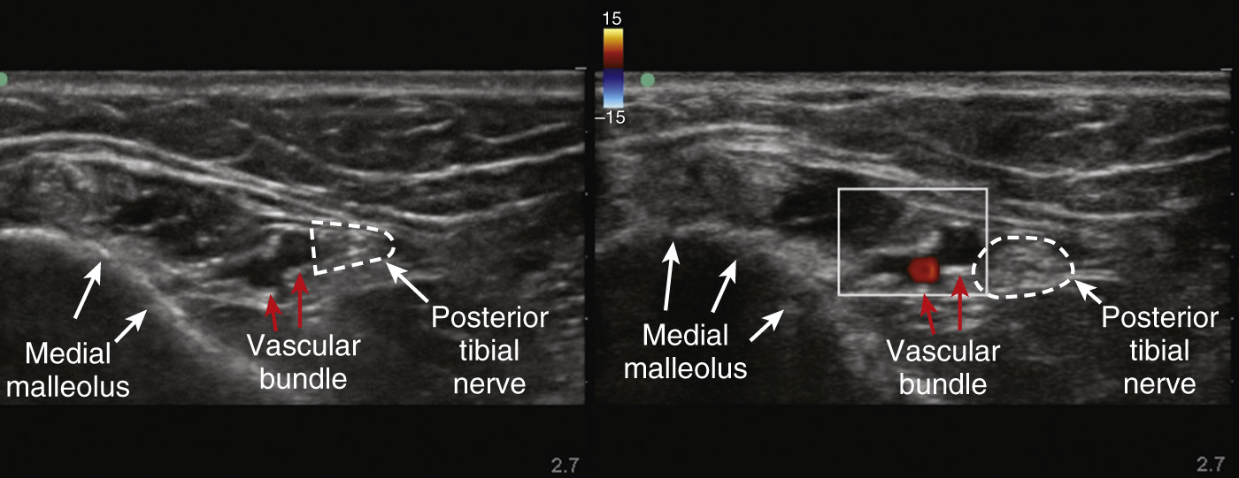 A two-part ultrasound scan showing the medial ankle region with vascular and nerve structures.