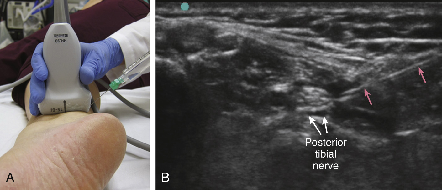 Part A, a clinical photograph of ultrasound scanning of the ankle; Part B, ultrasound scan labeling posterior tibial nerve.