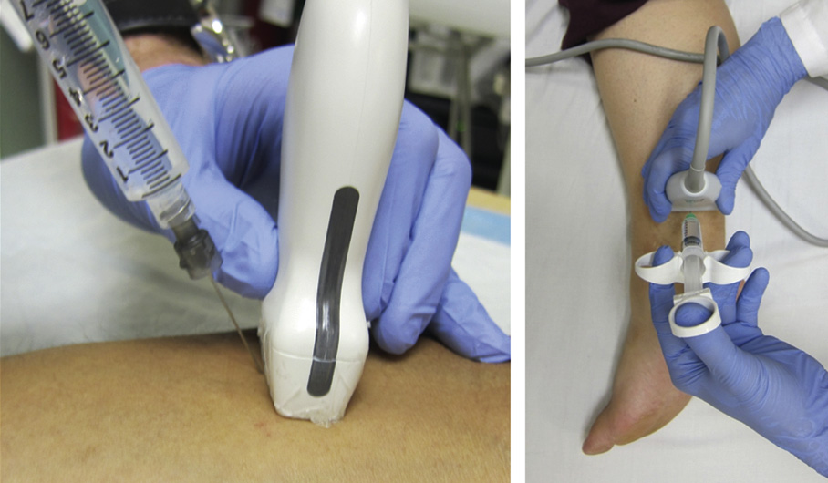 A two-part clinical photograph of needle insertion guided by ultrasound.