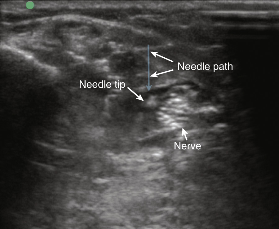 An ultrasound scan showing a labeled needle tip and nerve.