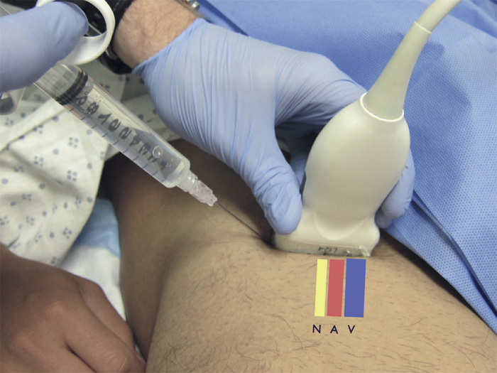 A clinical photograph of ultrasound-guided femoral nerve block.
