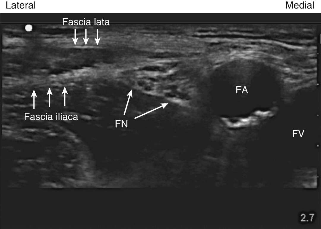 An ultrasound scan of the femoral nerve and adjacent structures.